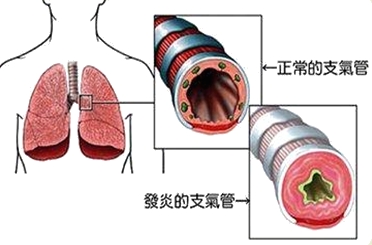 2024年广东执业药师《药综》常考点：急性气管-支气管炎
